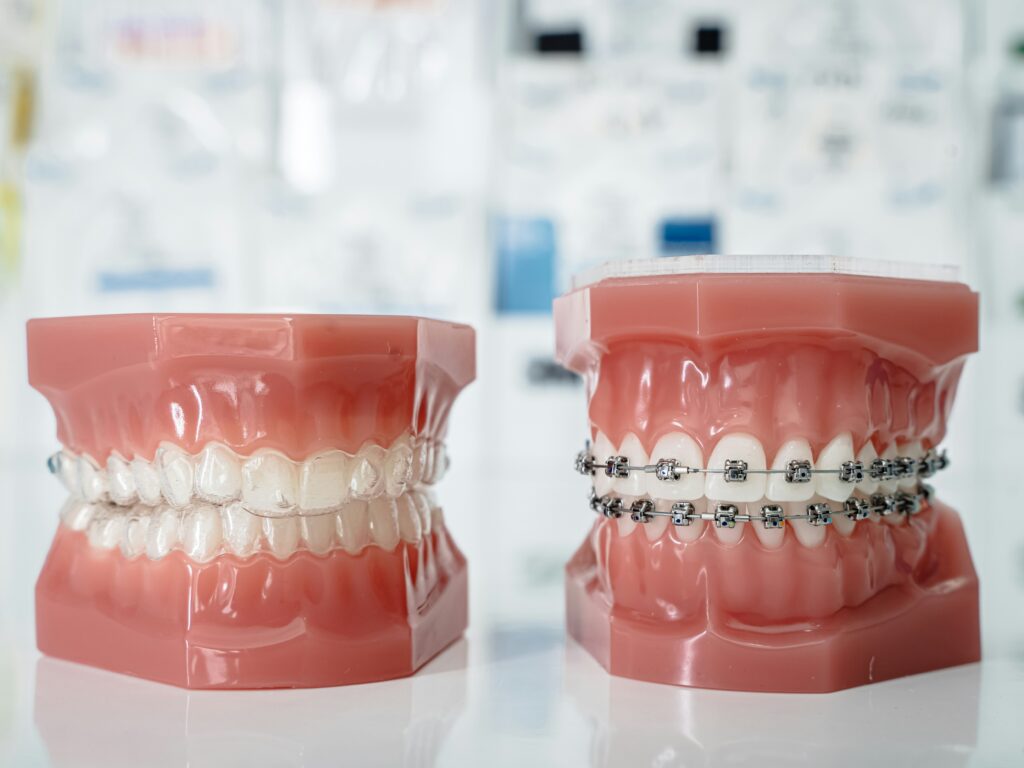 Tooth care braces invisalign